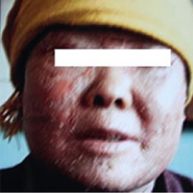 红皮症型银屑病