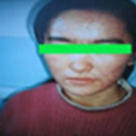 治疗后