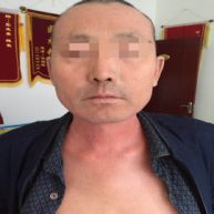 银屑病