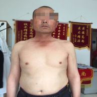 银屑病