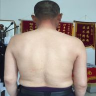 银屑病