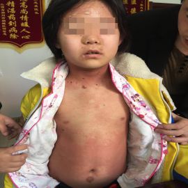 治疗前